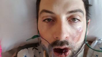GRAPHIC: Man Claims That His E-Cigarette Exploded In His Face And The Photos Are Horrifying