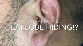 Here’s Dr. Pimple Popper Removing Earlobe Cyst On This Man’s Head