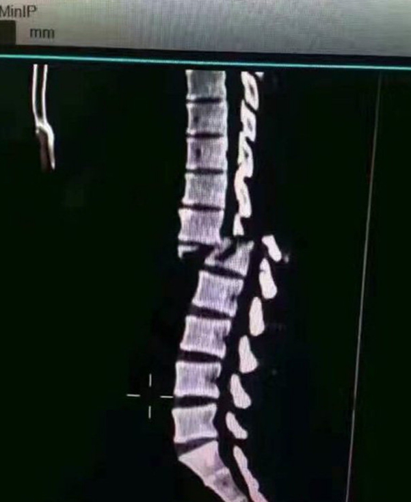 Chinese Man Allegedly 'Snaps His Vertebrae' After Trying To Deadlift