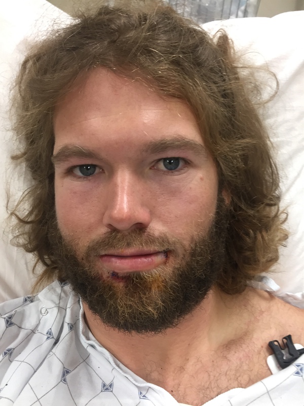 Skier Impaled In Face By Tree Branch