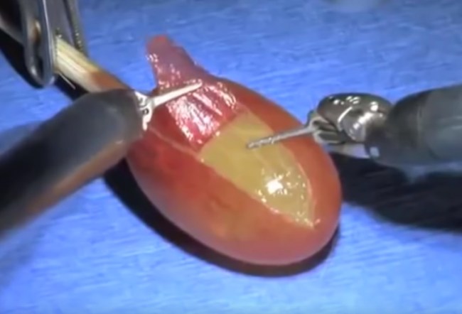 they_did_surgery_on_a_grape