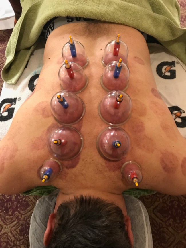 Cupping theray