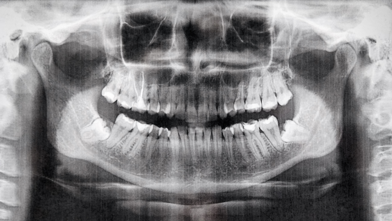 7YearOld Boy Has 526 Teeth Removed After Experiencing Pain In His Jaw