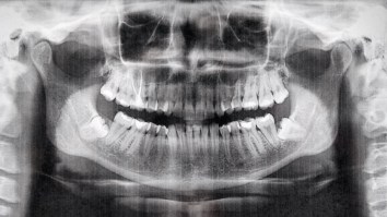 7-Year-Old Boy Has 526 Teeth Removed After Experiencing Pain In His Jaw