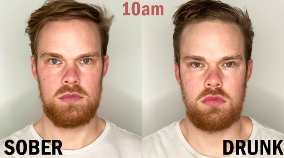 alcoholic face changes