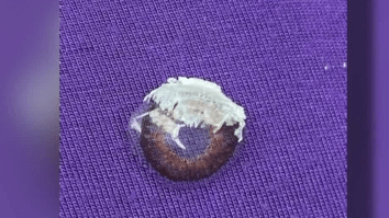 Woman Accidentally Glues Her Eye Shut After Mistaking Nail Glue For Eye Drops