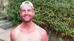 extremely red sunburned Summer tourist