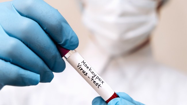 test tube with Monkeypox virus infected blood sample