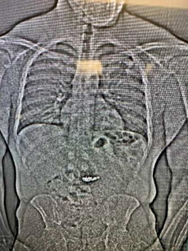 X-ray of man who swallowed jewelry after robbing Tiffany earrings