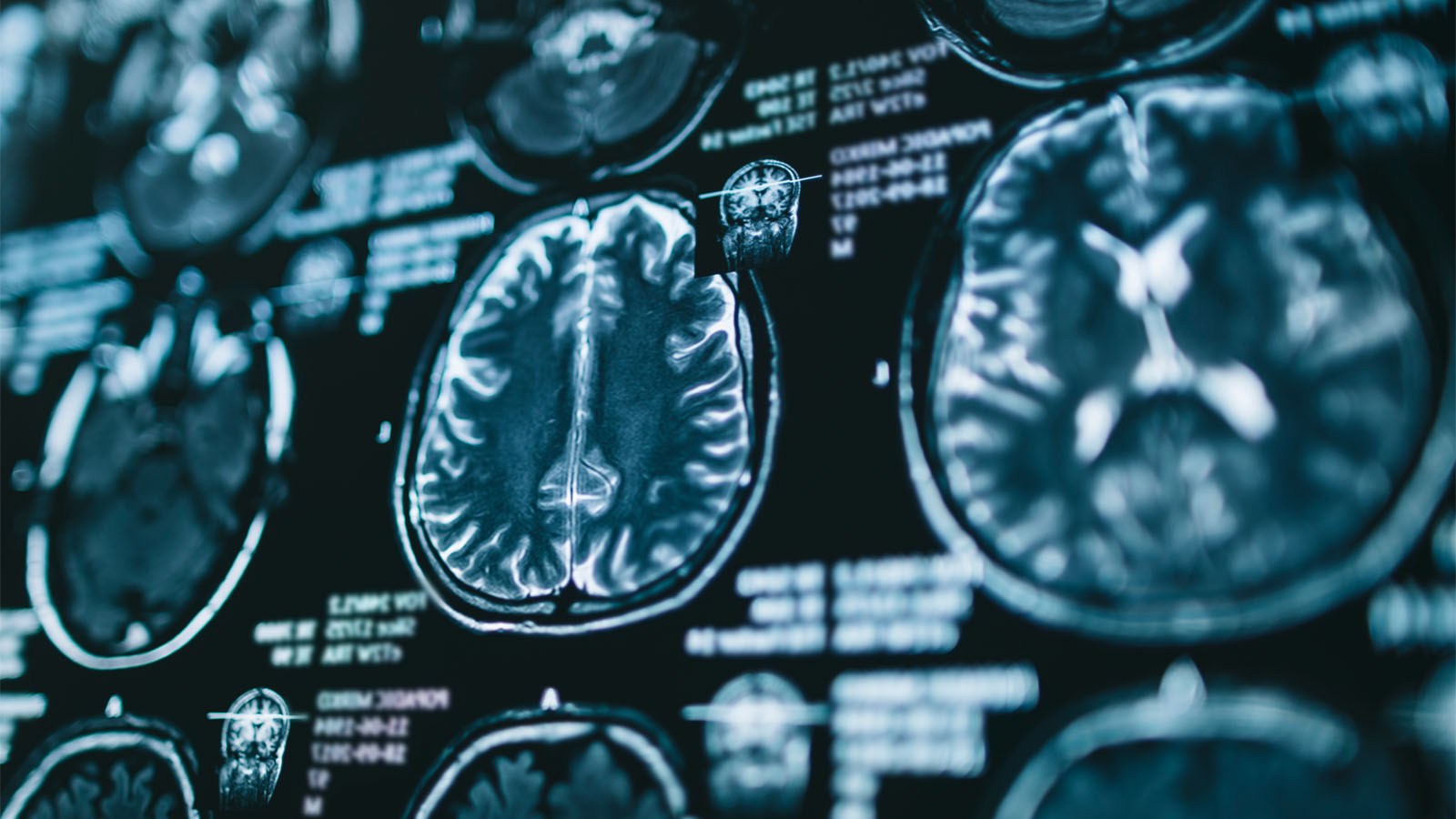 Rare '100% Fatal' Brain Disease Strikes 3 People In Oregon