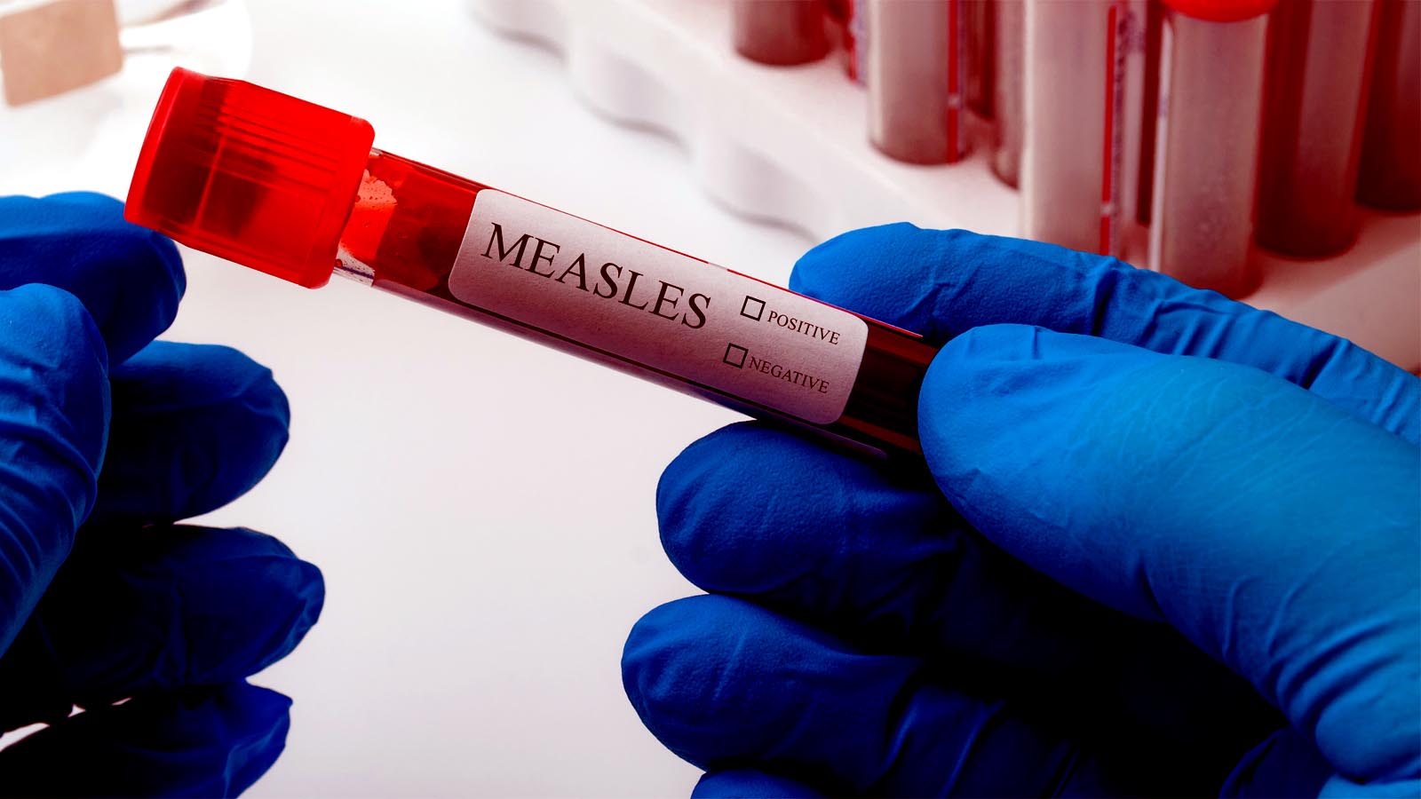 US Measles Cases Reach Highest Level In 30 Years Thanks To Outbreaks In South Carolina, Arizona, And Utah