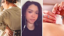 Woman Gets Acupuncture. 10 Hours Later, She Pulls Something Sharp Out Of Her Neck